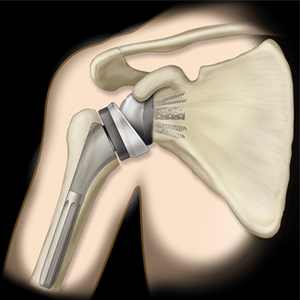 Arthroscopy
